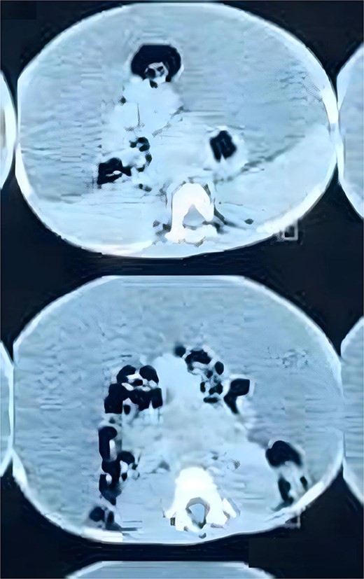 Axial view of CT abdomen and pelvis demonstrates the cystic lesion entrapping the bowel loops centrally