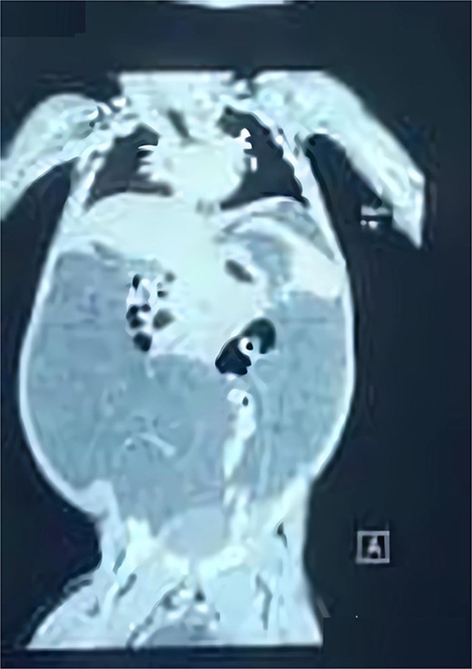 coronal view of CT abdomen and pelvic demonstrates the scrotal extent of abdominopelvic cystic lesion
