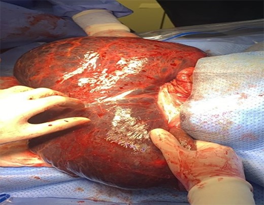 Omental cyst. Origin: greater omentum (arrow).