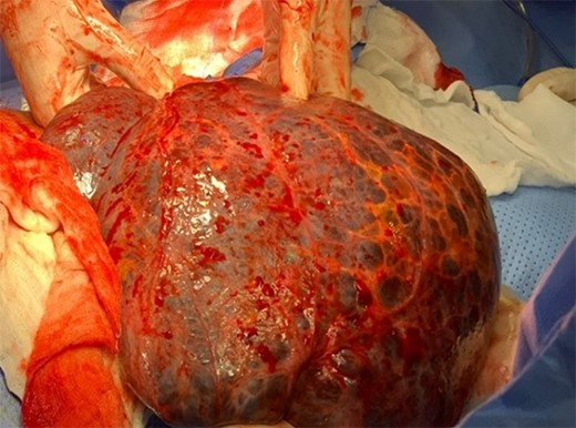 Intraoperative delivery of omental cyst for excision.