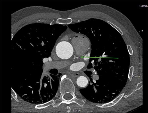 CCTA showing the CPF originating from the proximal LAD (green arrow).