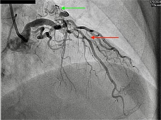 Coronary angiography showing diffuse stenosis in the LAD (red arrow) and CPF (green arrow).