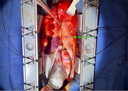 Intra-operative picture showing the CPF (green arrow).