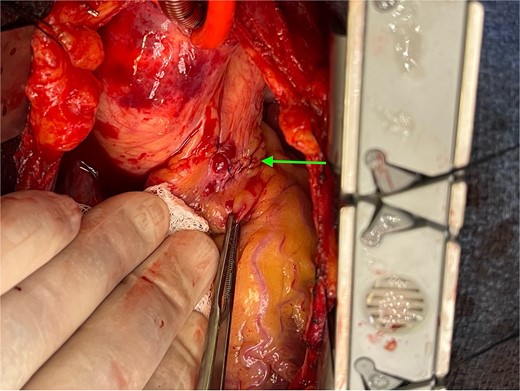Ligation of coronary to pulmonary artery fistula with figure-of-eight sutures.