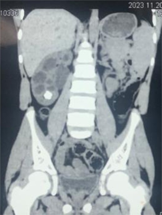 CT scan demonstrating stone in lower pole of right kidney.