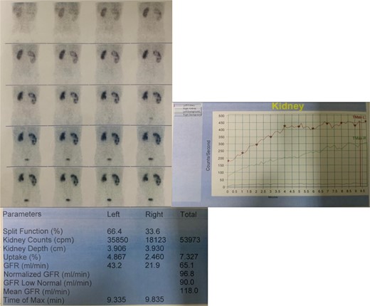 DTPA scan of the patient depicting GFR of right kidney to be 21.9 ml/min.