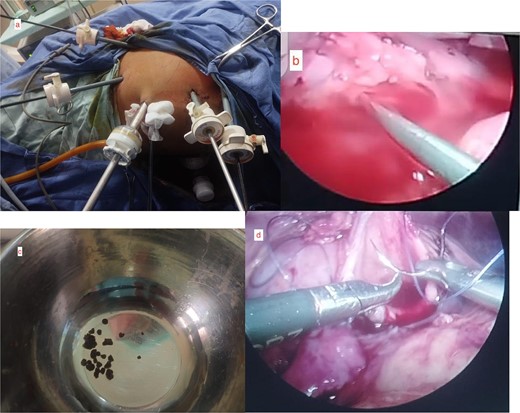 Intraoperative pictures. (a) Assembly of laparoscopic ports. (b) Insertion of URS through the laparoscopic port. (c) Retrieved fragments of 12.9 mm stone from minor calyx. (d) LP repair.