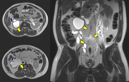Abdominopelvic MRI T2WI demonstrating severe bilateral hydroureteronephrosis (yellow arrows) with thinning of the right renal cortex (blue arrow).