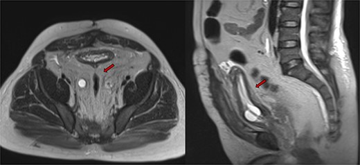 Abdominopelvic MRI T2WI PL surrounding urinary bladder and rectum (red arrow).