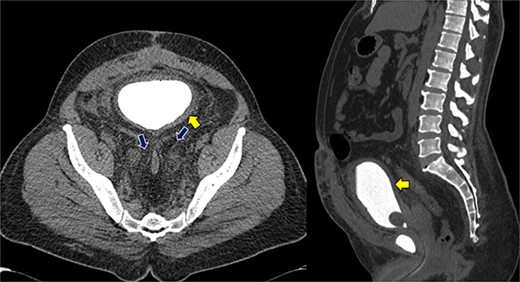 Axial and sagittal CT cystogram demonstrating urinary bladder wall thickening (yellow arrow) with PL and extensive fat strandings (blue arrows).