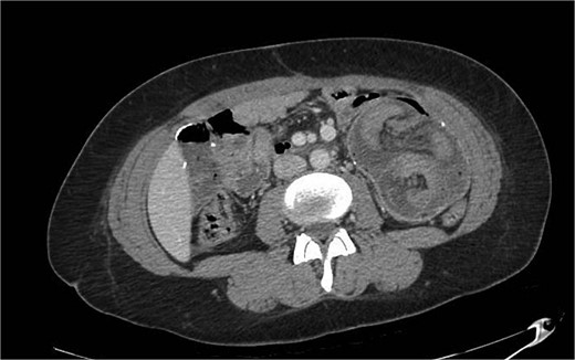CT of the jejunojejunostomy intussusception.