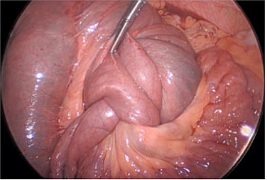 Intraoperative view of the jejunojejunostomy intussusception.