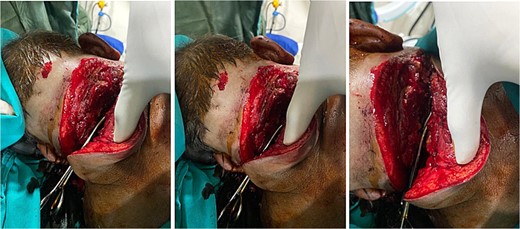 Three pictures revealing the circumferential deep cut of the neck.
