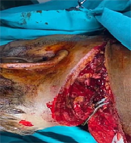 Posterior view showing the laceration of all neck muscles (The neck muscles include the platysma, digastric, stylohyoid, mylohyoid, geniohyoid, sternohyoid, omohyoid, sternothyroid, thyrohyoid, longus colli, longus capitis, rectus capitis anterior, rectus capitis lateralis, scalenus anterior, scalenus medius, scalenus posterior, rectus capitis posterior major, rectus capitis posterior minor, obliquus capitis superior, obliquus capitis inferior, sternocleidomastoid, and trapezius).