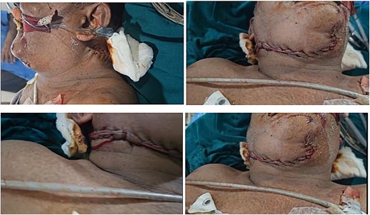 Four pictures showing the surgical intervention that involved ligation of the posterior neck vessels, suturing of bleeding points, end-to-end muscle repair with Vicryl 1–0, placement of a drainage tube in the posterior neck, and skin closure.