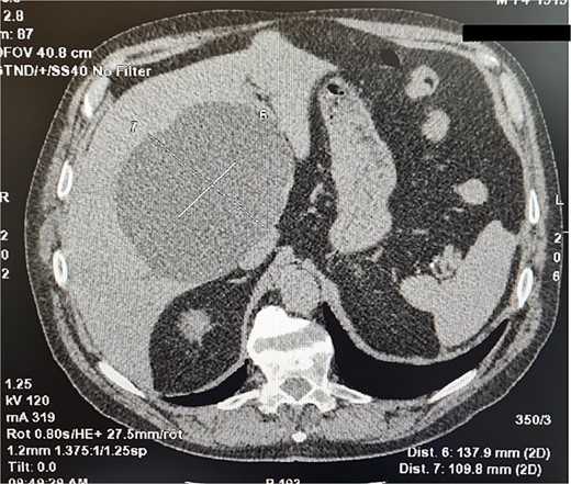 Computed tomography imaging of the liver cyst.