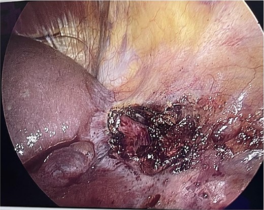 Anterior surface of the liver cyst-(laparoscopic view).