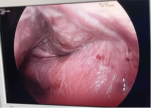 Laparoscopic view of the cyst inside.