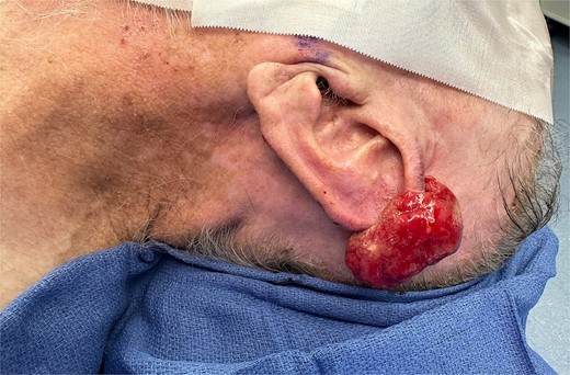 Gross representation of left auricular helix mass with a violaceous and fleshy appearance.