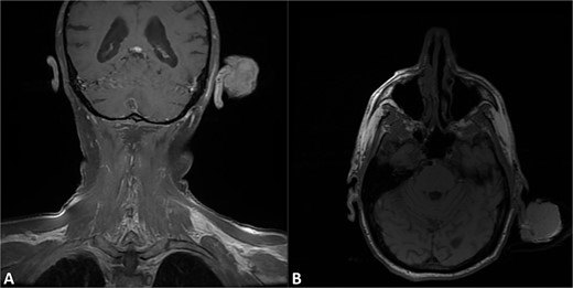 T1 fat-suppressed post-contrast MRI of the head in the A) coronal and B) axial sections demonstrating pedunculated mass of the left helix with preservation of the underlying cartilaginous structures.