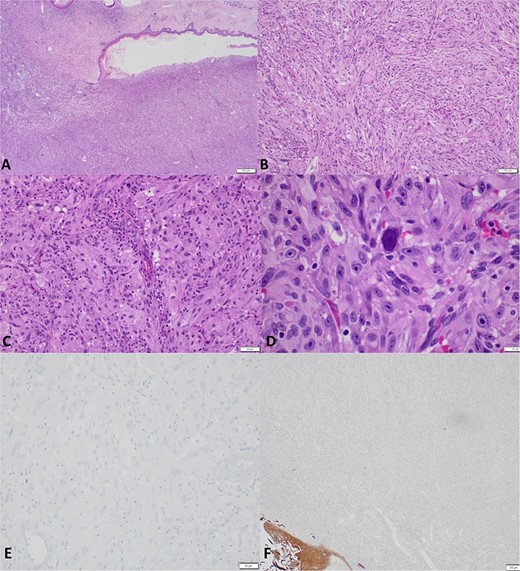 Representative histologic specimens at A) 20× demonstrating primarily spindle celled tumor with adjacent ulceration into normal tissue, B) 100× demonstrating spindle and epithelial morphology with local inflammation, C) 200× demonstrating nuclear pleomorphism, and D) 600× with significant pleomorphism with relatively low mitotic activity. E) Immunostaining displaying tumor cells negative for S100 (200×). F) A cytokeratin immunostaining highlights the normal squamous epithelium (lower left) but negative in the tumor cells (pankeratin AE1/AE3, 40×).