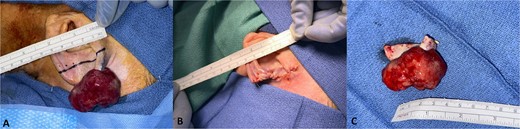 Intraoperative photos of A) the lesion in situ, B) status post partial auriculectomy, and C) specimen with negative tumor margin.
