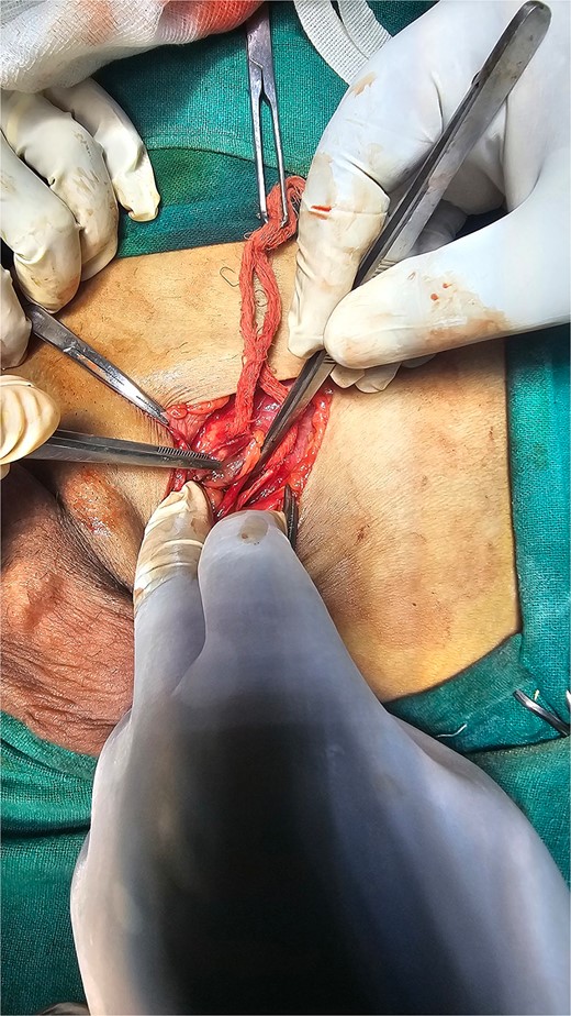 Duplicated vas deferens emerging from a single testicle during spermatic cord dissection during operative procedure.