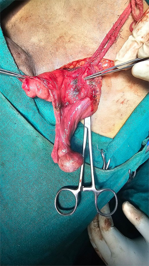 Duplication of vas deferens.