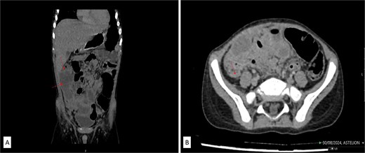 (A) Contrast-enhanced abdominal CT in coronal and axial scans showed an irregularly shaped mass in the right abdomen (labeled) in the form of extensive inflammatory mass which is in the close contact with the inferior liver surface, involving parts of ascending colon, cecum, and terminal ileum. (B) Retrocecal tubular structure (labeled) inseparable of dorsal wall of coecum which can correlate to the operative findings of second appendix.