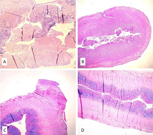 Histopathology confirmed a fragmentary finding of severe acute transmural appendicitis and thick fibrinopurulent deposits in one specimen (A, B) and secondary inflammation of appendiceal tissue with fibrinopurulent deposits on the serosa in the other (C, D) (hematoxylin and eosin/H&E/stains, magnification 10×).