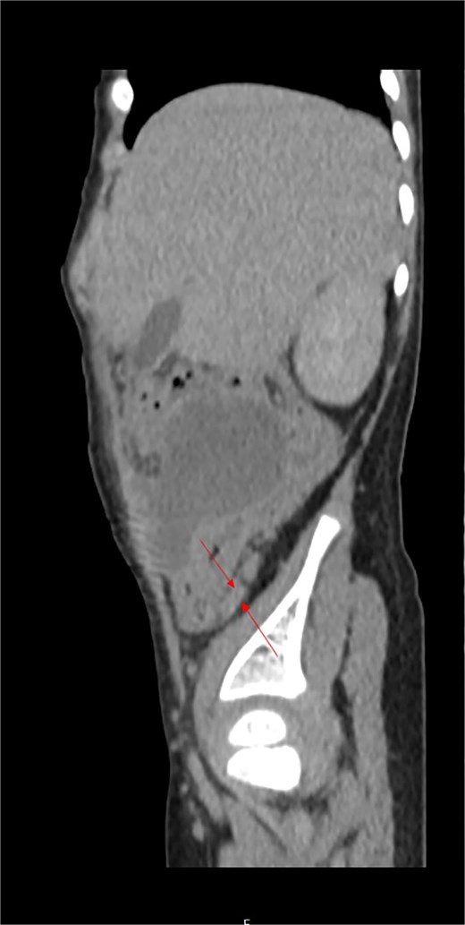 Postoperatively analyzed preoperative contrast-enhanced sagittal abdominal CT scan detected a retrocecal 24.1 mm long tubular structure (a smaller second secondary inflamed appendix) with a transverse diameter of 5.6 mm and a wall thickness of 1.8 mm adherent to/inseparable from the dorsal wall of the cecum (labeled).