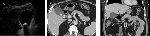 Ultrasound demonstrates gallbladder wall thickening (solid white arrow in A) and gallstone (* in A). Contrast enhanced CT of the abdomen in portal venous phase axial (B) and coronal (C) planes demonstrate gallbladder wall thickening (solid white arrow in C) and area of nonenhancing wall (dashed white arrow in B and C) and gallstones (* in B).