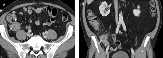 Contrast enhanced axial (A) and coronal (B) CT images in portal venous phase demonstrate periappendiceal abscesses (solid arrows) closely associated with thick-walled and inflamed tip of the appendix (dashed arrows). Note the normal appearing base of the appendix (arrowhead in A).