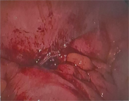 Intraoperative photographs of gangrenous gallbladder.