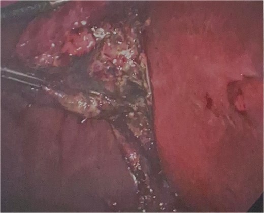Intraoperative photograph of inflamed, perforated appendix.