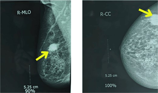 Mammography showing well-defined high-density mass lesions of 3.5 × 3.5 cm with spiculated margins in the upper outer quadrants of right breast.