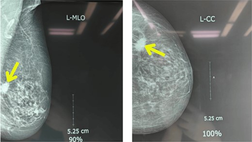 Mammography showing well-defined high-density mass lesions of 3.5 × 3.5 cm with spiculated margins in the upper outer quadrants of left breast.