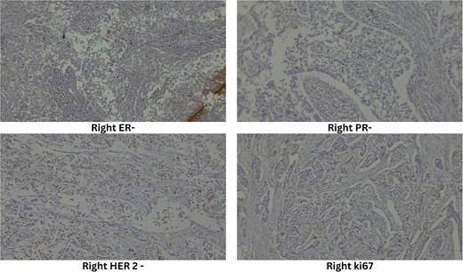 Immunohistochemistry of right breast.