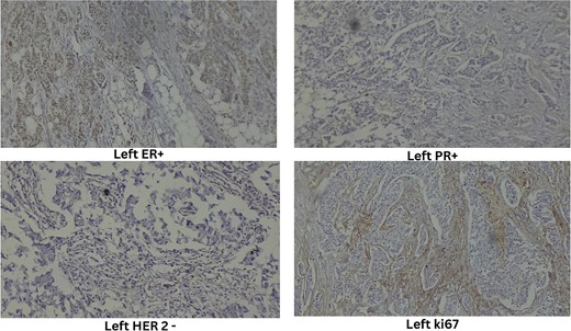 Immunohistochemistry of left breast.