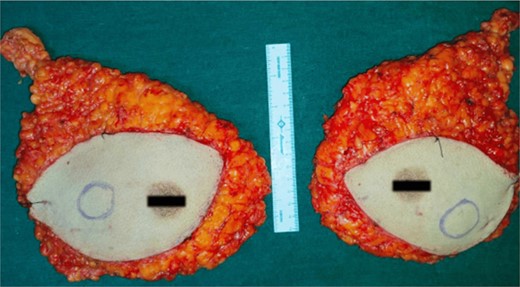 Bilateral MRM specimen.