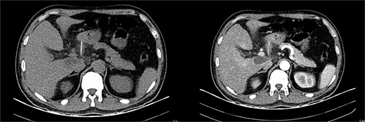 (A) CT, the fishbone is seen in the lesser sac. (B) Contrast enhanced CT, the fishbone is seen free in the lesser sac in close contact to the pancreas.
