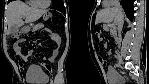 CT, the location of the fishbone in the lesser sac embedded in the pancreas.