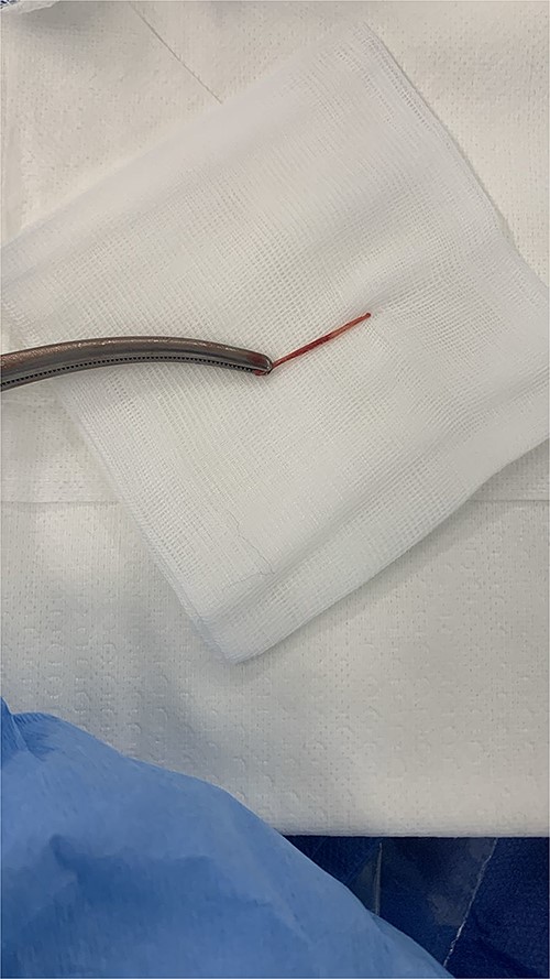 The extracted fishbone.