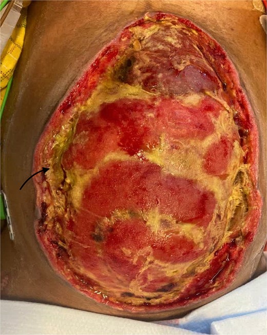 Frozen abdomen of the patient showing adhered loops of bowel and the lower lobe of the liver. The arrow represents the location where the patients fistula was located.