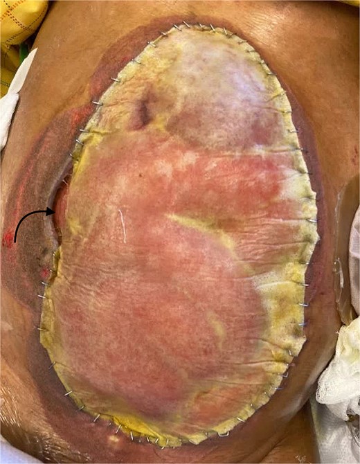 Novosorb BTM on the abdomen with the laminte layer still on. The black arrow represents the location of the fistula.