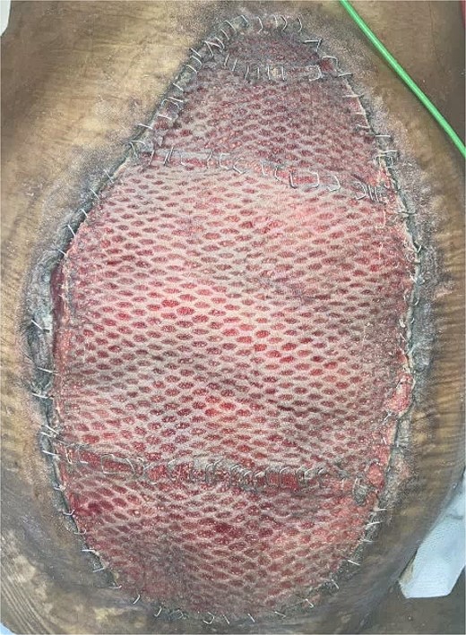 Skin grafting of the Novosorb BTM.