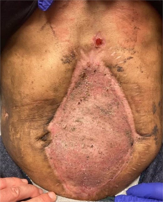 The patients skin graft after complete epithilization.
