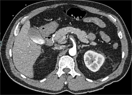 CTA abdomen and pelvis demonstrating 75% SMA stenosis secondary to SMA dissection with thrombosis of the false lumen.