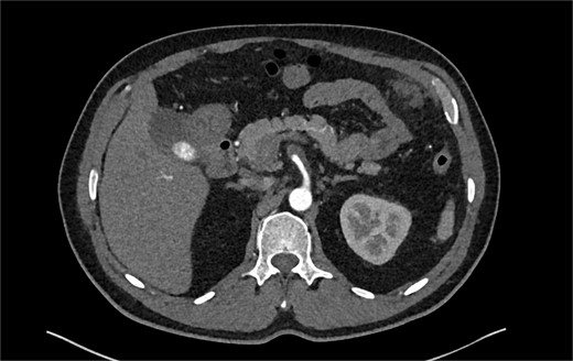 CTA demonstrating a more extensive SMA dissection extending into branch vessels. New hemoperitoneum most pronounced in the left abdomen with no active extravasation noted but probably arises from the left mesentery.