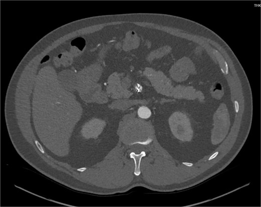 CTA demonstrating interval embolization of SMA at site of prior thrombus and dissection.